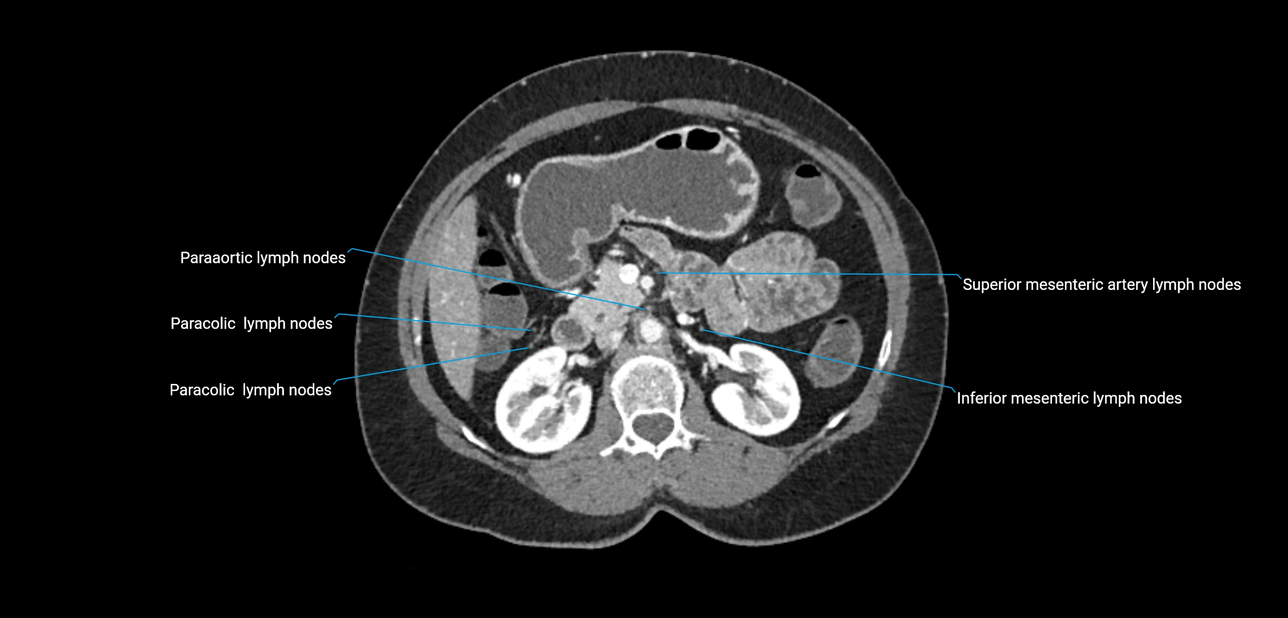 CT ct abdominal lymph nodes  axial cross sectional anatomy  enchanced radiology image -img-00002-00177.webp